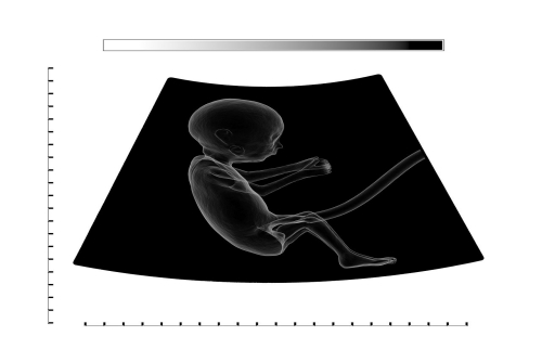 胎儿超声影像